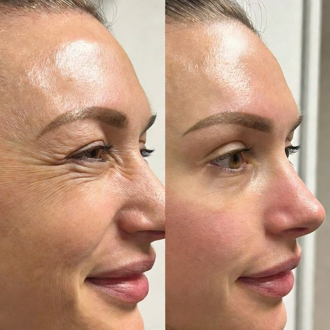 Comparativo de antes e depois de tratamento estético facial