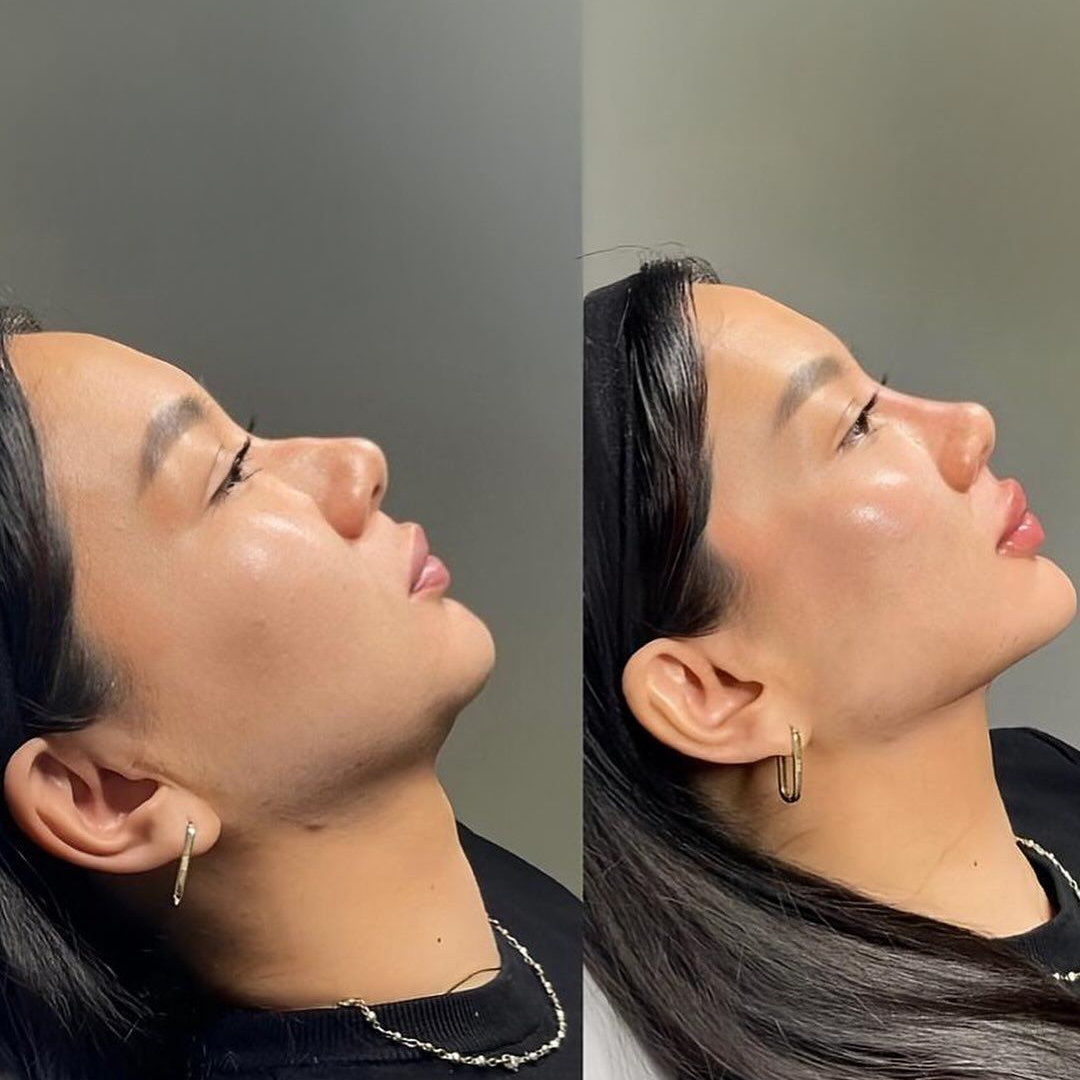 Comparativo de antes e depois de procedimento estético no perfil facial