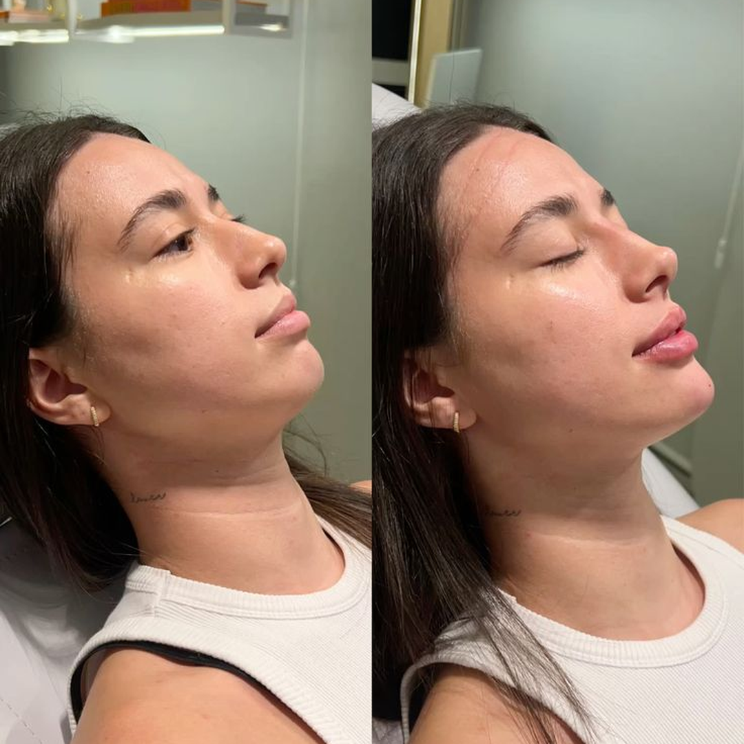 Comparativo de antes e depois de tratamento de harmonização facial